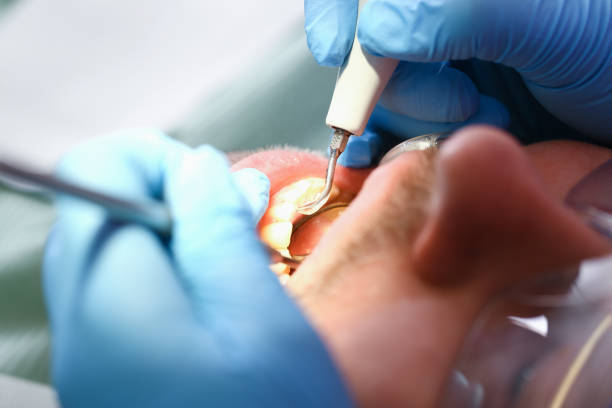 Emergency Dental Filling Replacement in WI